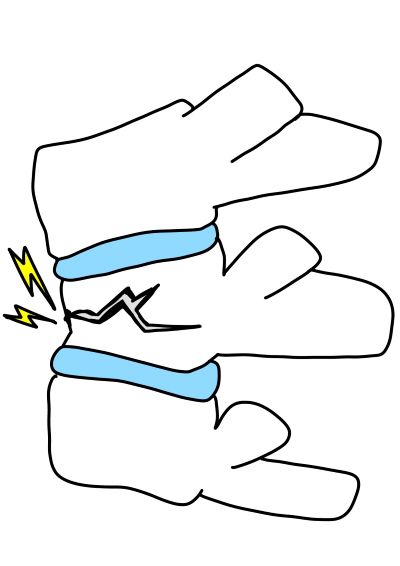 圧迫骨折後の腰痛お尻の痛み1