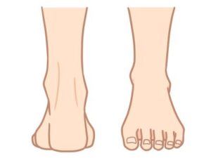 足首つまり１