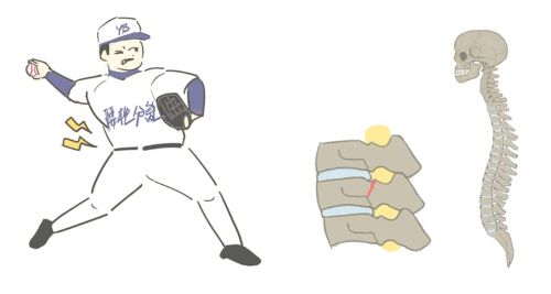 分離すべり症の腰痛2