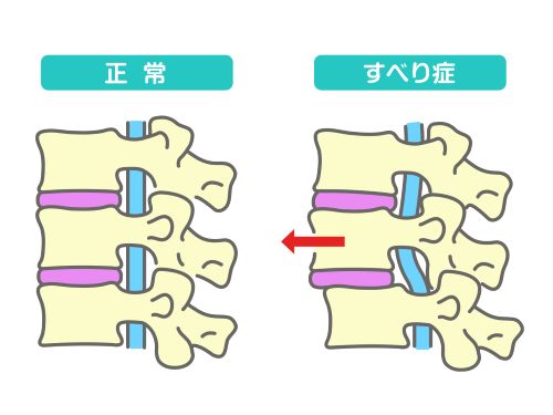 分離すべり症の腰痛3