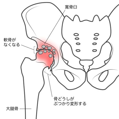 変形性股関節症の名医2
