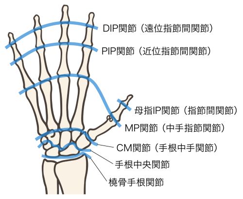変形性手関節症2