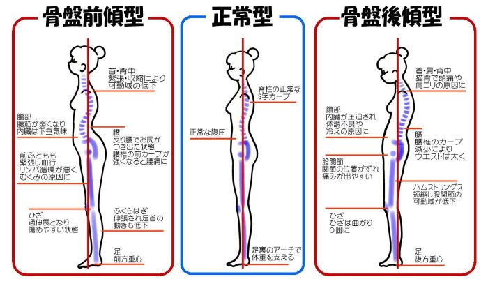 骨盤のずれ１