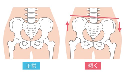 骨盤のずれ２