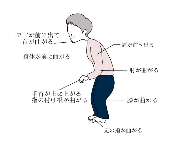 パーキンソン病３
