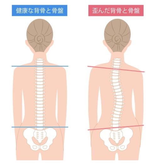 背骨のずれ１