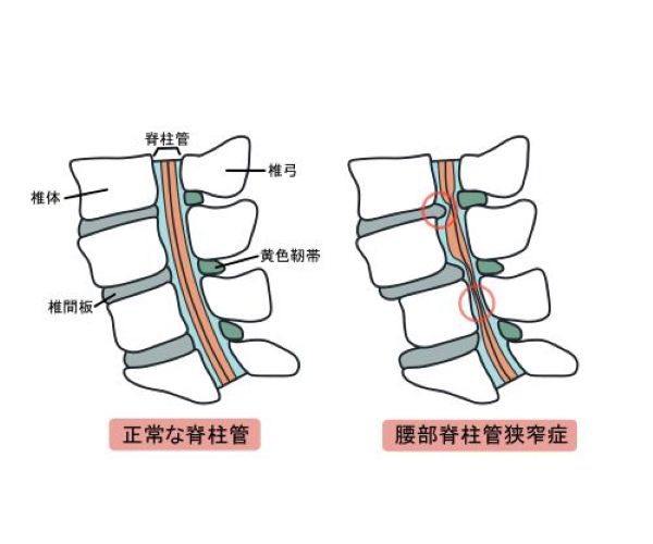 脊柱管狭窄症名医2