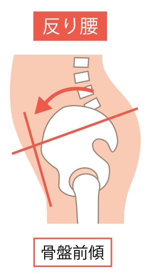 反り腰腰痛３