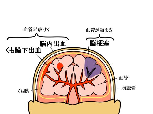 脳卒中の後遺症で悩んでいませんか