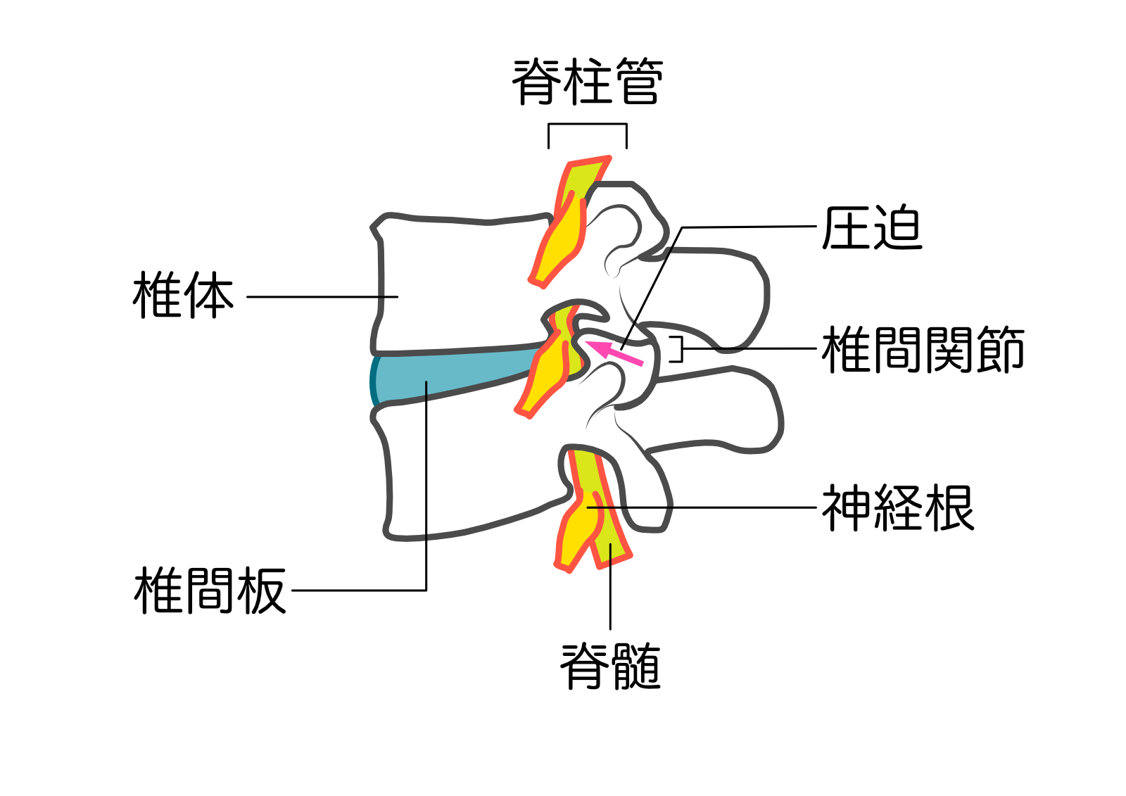 変形性脊椎症のイメージ